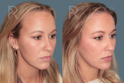 Brow and Hairline Advancement<span class=small>By Dr. Austin Adams</span> Before & After Gallery - Patient 126256 - Image 1