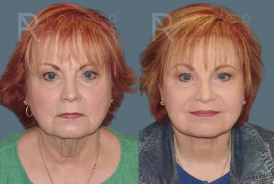 Facelift <span class=small>By Dr. Daniel Rousso</span> Before & After Gallery - Patient 117883 - Image 2
