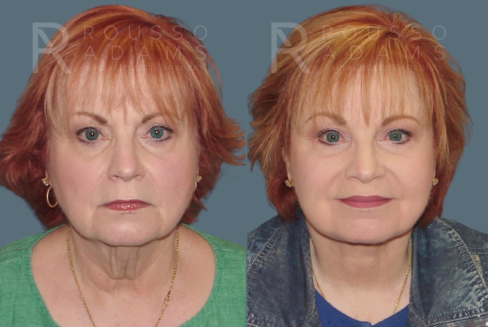 Facelift <span class=small>By Dr. Daniel Rousso</span> Before & After Gallery - Patient 117883 - Image 2