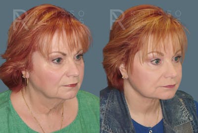 Facelift <span class=small>By Dr. Daniel Rousso</span> Before & After Gallery - Patient 117883 - Image 1