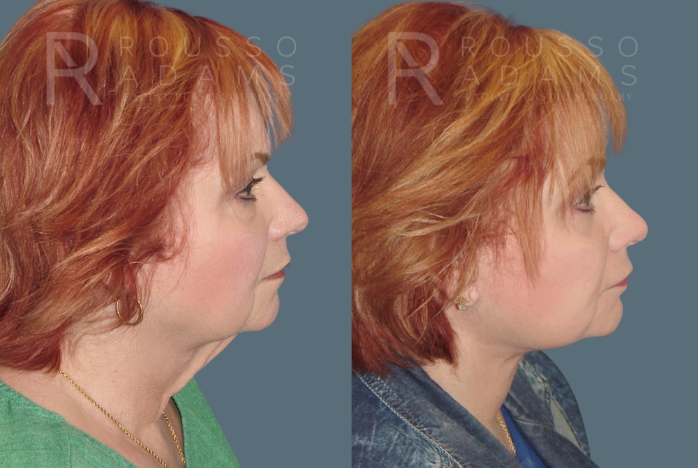 Facelift <span class=small>By Dr. Daniel Rousso</span> Before & After Gallery - Patient 117883 - Image 3