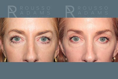 Blepharoplasty<span class=small>By Dr. Austin Adams</span> Before & After Gallery - Patient 198381 - Image 1