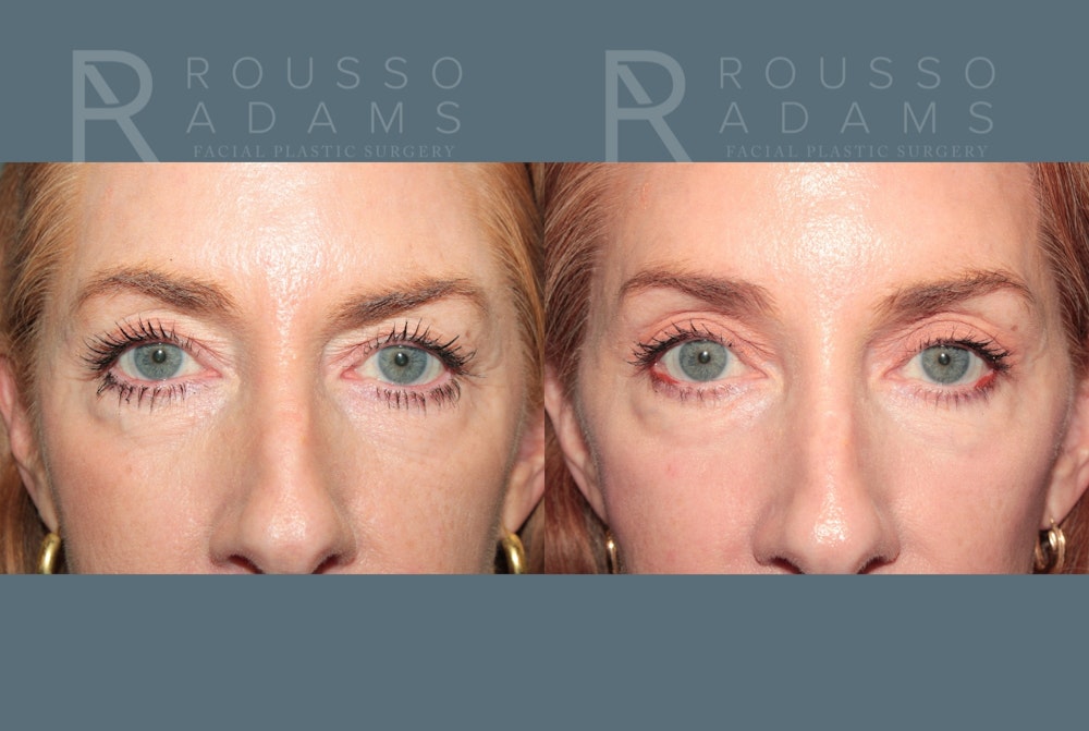 Blepharoplasty<span class=small>By Dr. Austin Adams</span> Before & After Gallery - Patient 198381 - Image 1