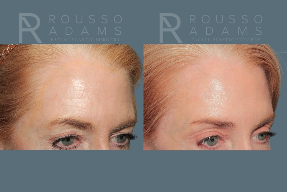 Blepharoplasty<span class=small>By Dr. Austin Adams</span> Before & After Gallery - Patient 198381 - Image 2