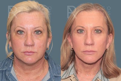 Facelift <span class=small>By Dr. Daniel Rousso</span> Before & After Gallery - Patient 387721 - Image 2