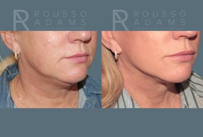 Facelift <span class=small>By Dr. Daniel Rousso</span> Before & After Gallery - Patient 387721 - Image 4