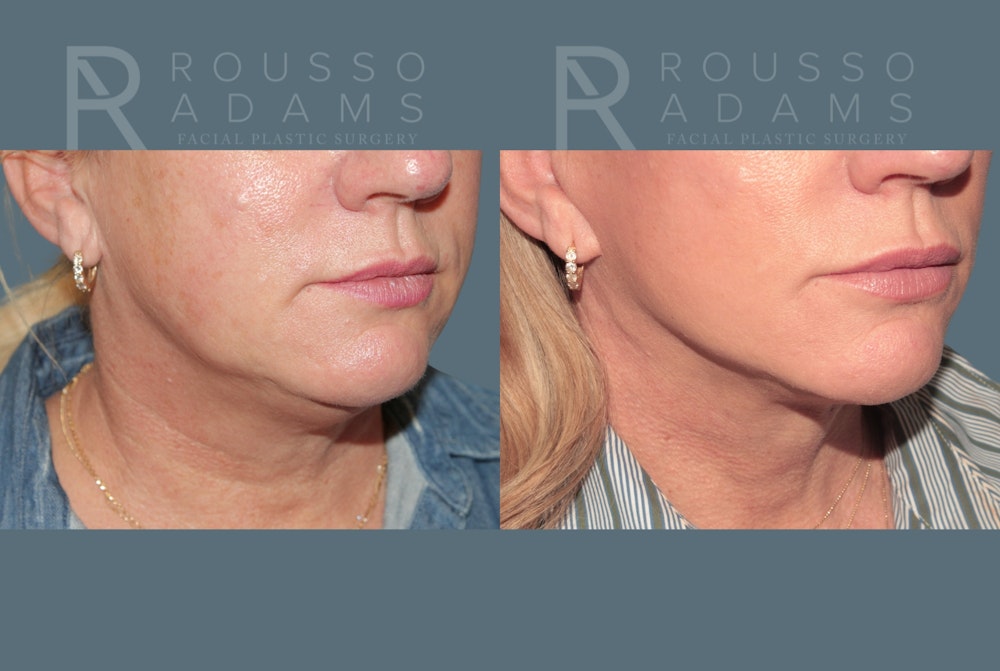 Facelift <span class=small>By Dr. Daniel Rousso</span> Before & After Gallery - Patient 387721 - Image 4