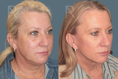 Facelift <span class=small>By Dr. Daniel Rousso</span> Before & After Gallery - Patient 387721 - Image 1