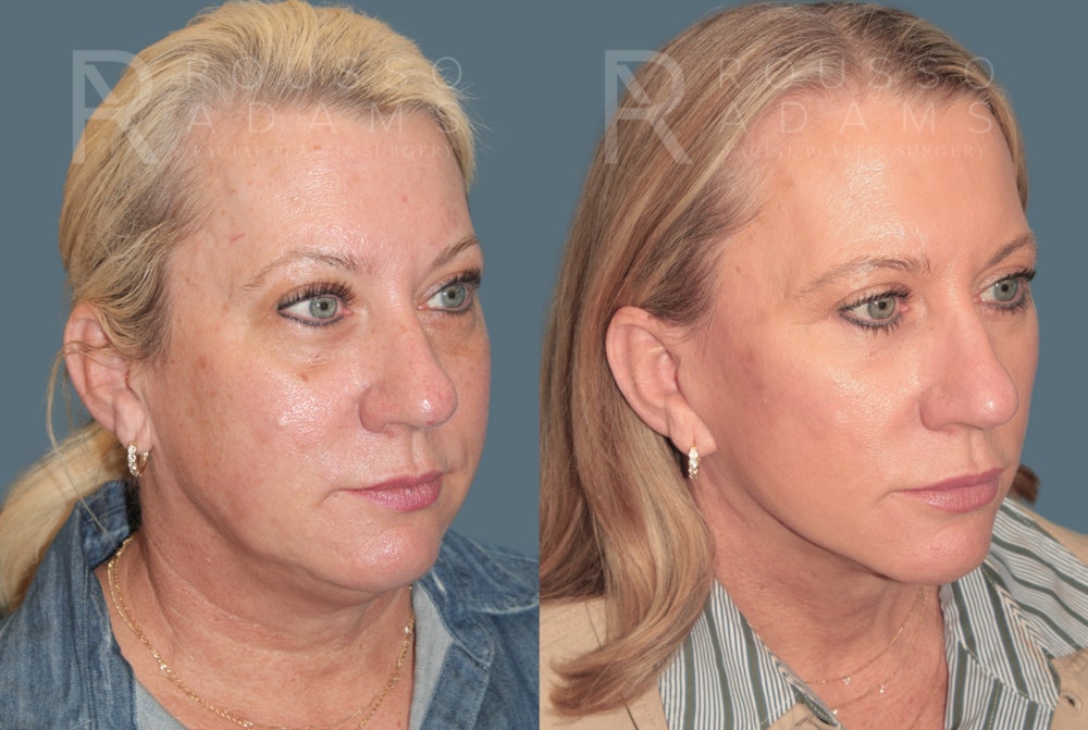 Facelift <span class=small>By Dr. Daniel Rousso</span> Before & After Gallery - Patient 387721 - Image 1