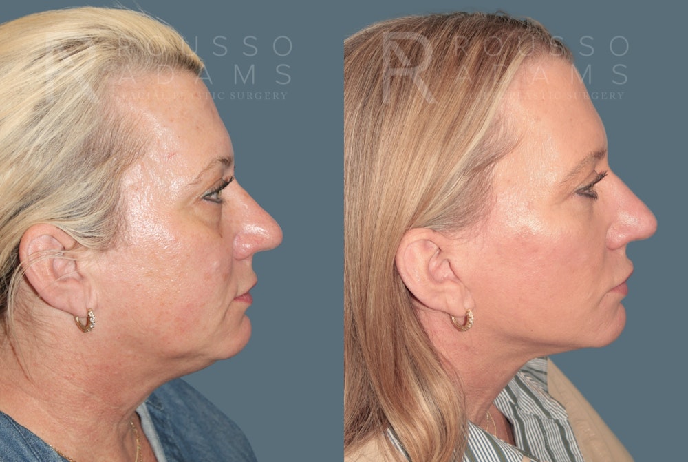 Facelift <span class=small>By Dr. Daniel Rousso</span> Before & After Gallery - Patient 387721 - Image 3