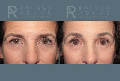 Deep Plane Facelift <span class=small>By Dr. Daniel Rousso</span> Before & After Gallery - Patient 862220 - Image 6