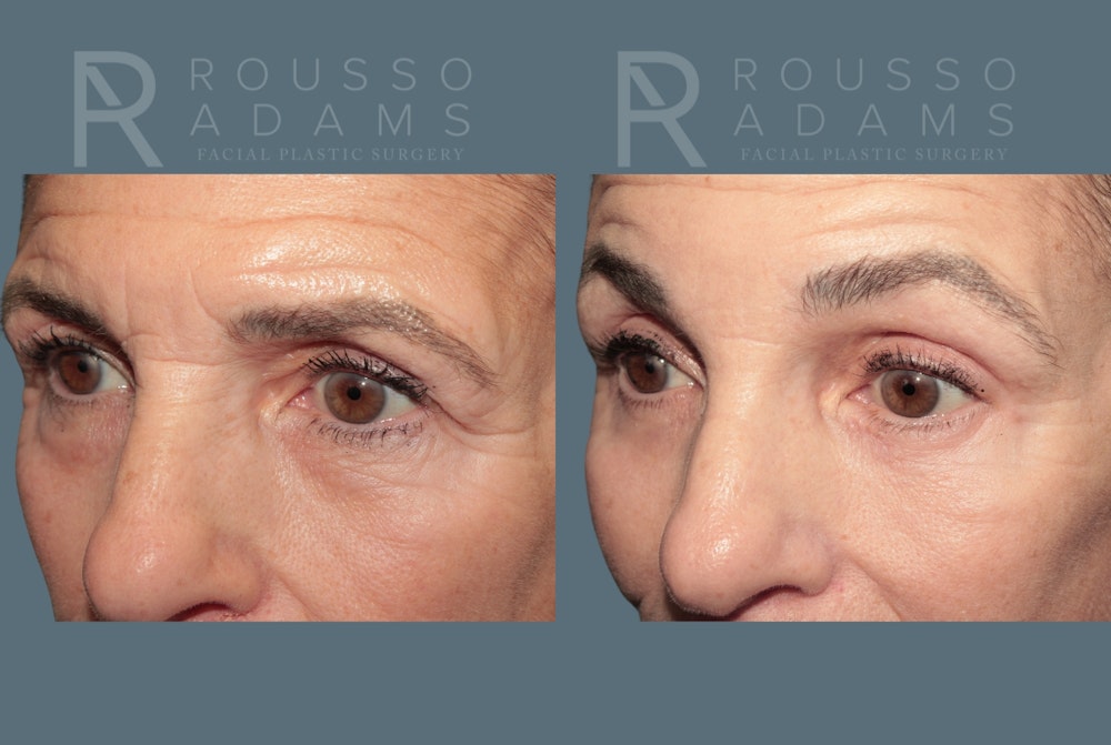Deep Plane Facelift <span class=small>By Dr. Daniel Rousso</span> Before & After Gallery - Patient 862220 - Image 7