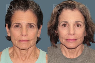 Deep Plane Facelift <span class=small>By Dr. Daniel Rousso</span> Before & After Gallery - Patient 862220 - Image 2