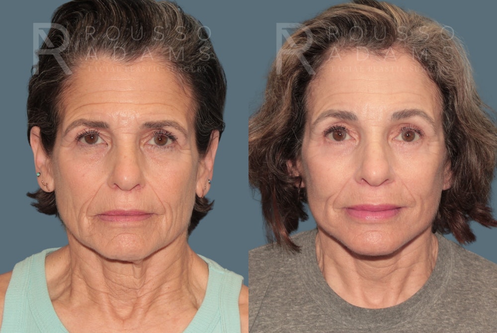 Deep Plane Facelift <span class=small>By Dr. Daniel Rousso</span> Before & After Gallery - Patient 862220 - Image 2