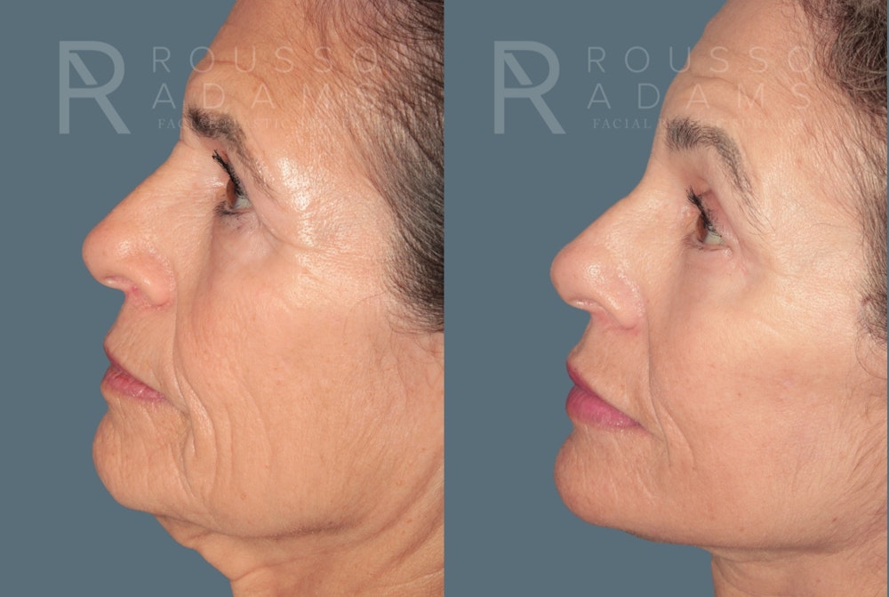 Deep Plane Facelift <span class=small>By Dr. Daniel Rousso</span> Before & After Gallery - Patient 862220 - Image 5