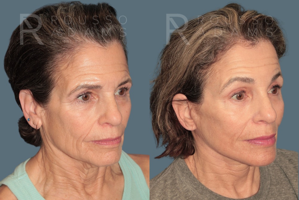 Deep Plane Facelift <span class=small>By Dr. Daniel Rousso</span> Before & After Gallery - Patient 862220 - Image 1