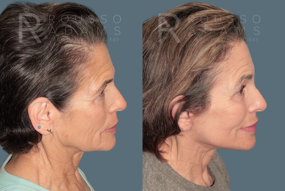 Deep Plane Facelift <span class=small>By Dr. Daniel Rousso</span> Before & After Gallery - Patient 862220 - Image 3
