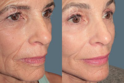 Deep Plane Facelift <span class=small>By Dr. Daniel Rousso</span> Before & After Gallery - Patient 862220 - Image 4