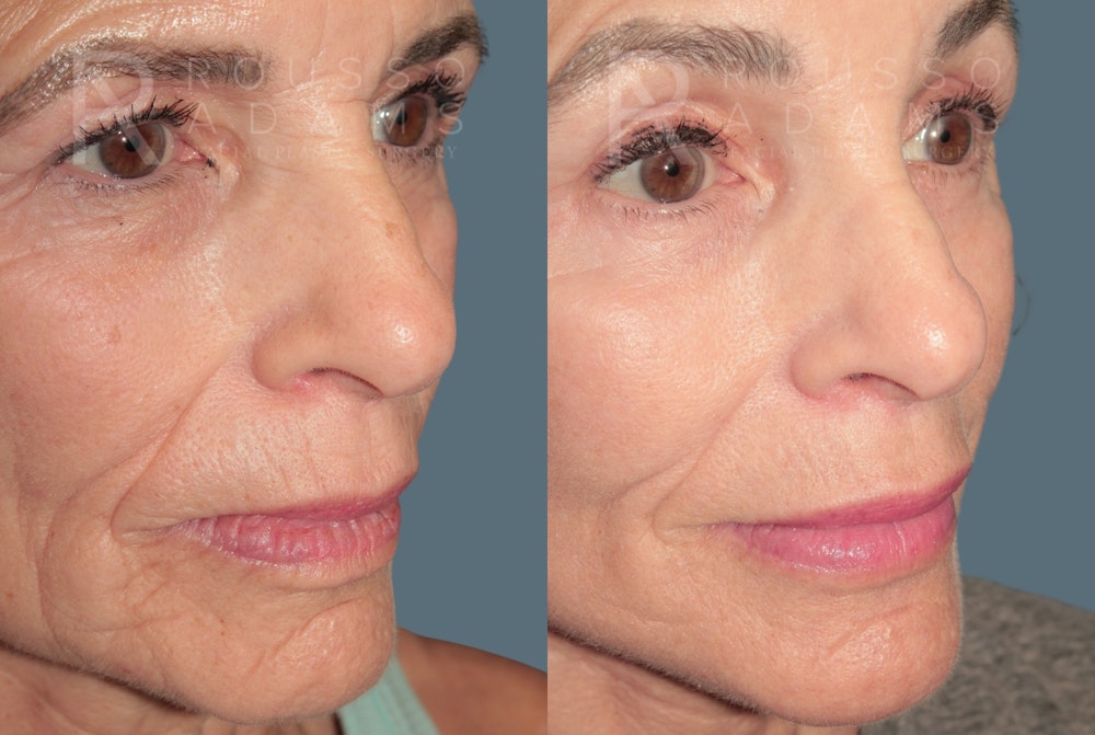 Deep Plane Facelift <span class=small>By Dr. Daniel Rousso</span> Before & After Gallery - Patient 862220 - Image 4