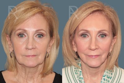 Deep Plane Facelift <span class=small>By Dr. Daniel Rousso</span> Before & After Gallery - Patient 214550 - Image 2