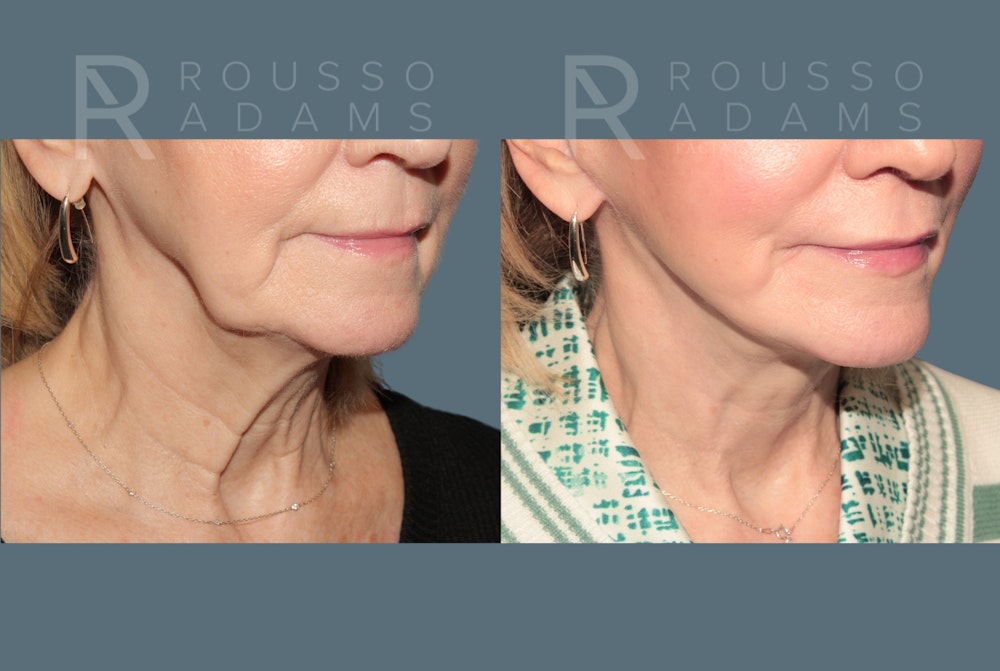 Deep Plane Facelift <span class=small>By Dr. Daniel Rousso</span> Before & After Gallery - Patient 214550 - Image 5