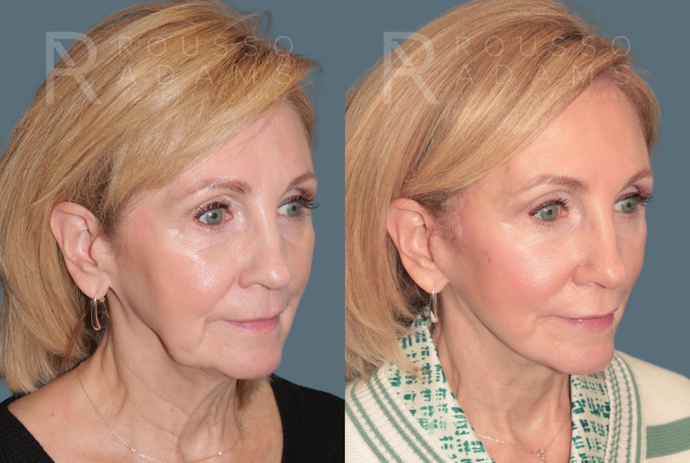 Deep Plane Facelift <span class=small>By Dr. Daniel Rousso</span> Before & After Gallery - Patient 214550 - Image 1