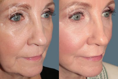 Deep Plane Facelift <span class=small>By Dr. Daniel Rousso</span> Before & After Gallery - Patient 214550 - Image 4