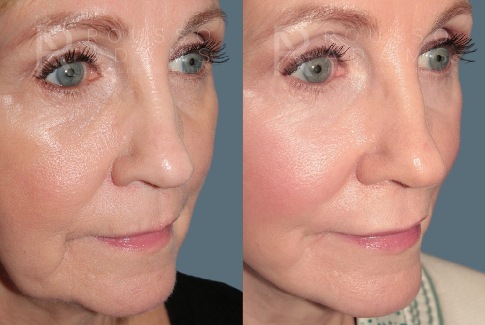 Deep Plane Facelift <span class=small>By Dr. Daniel Rousso</span> Before & After Gallery - Patient 214550 - Image 4