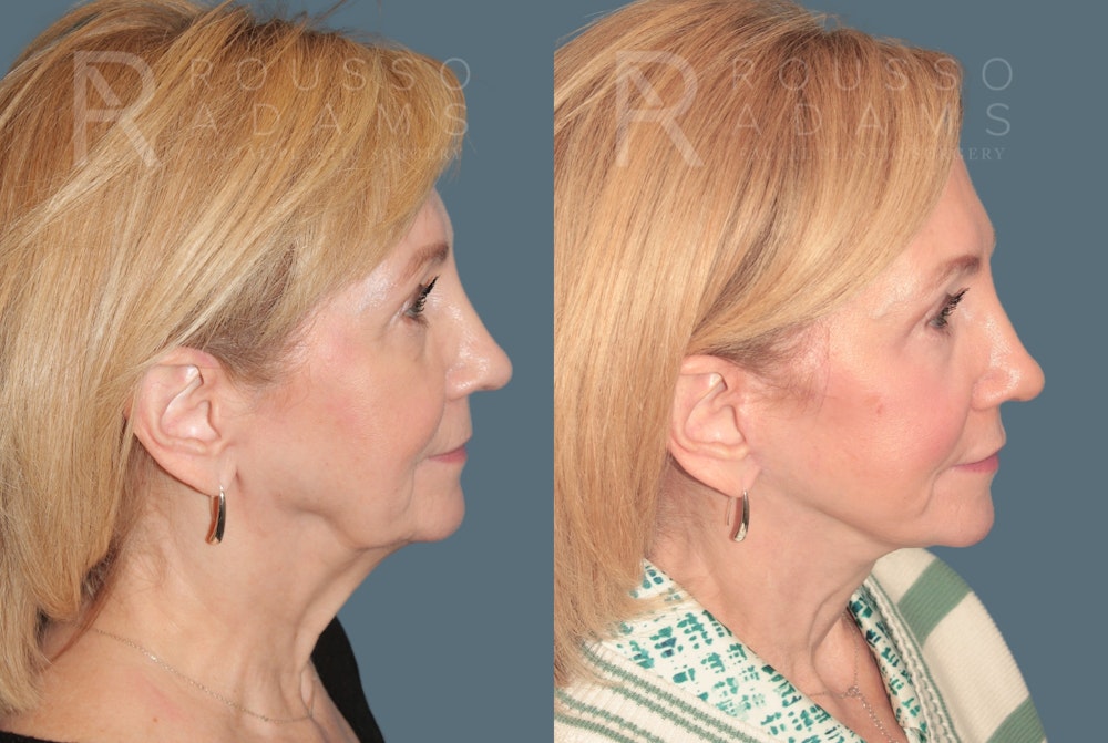 Deep Plane Facelift <span class=small>By Dr. Daniel Rousso</span> Before & After Gallery - Patient 214550 - Image 3