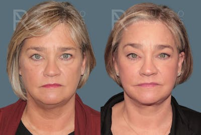 Deep Plane Facelift <span class=small>By Dr. Daniel Rousso</span> Before & After Gallery - Patient 381903 - Image 2