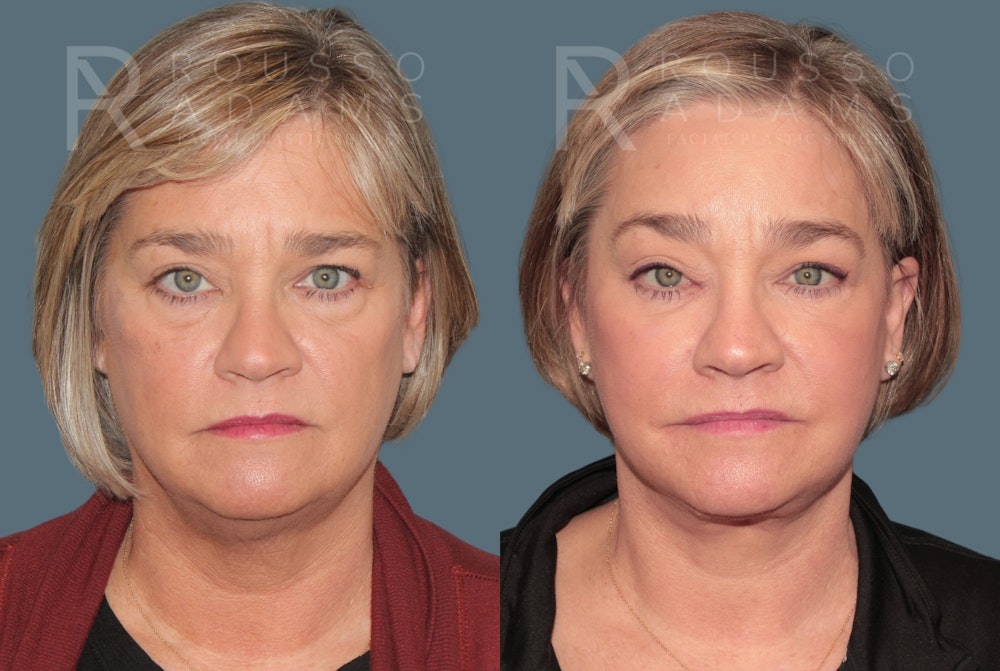 Deep Plane Facelift <span class=small>By Dr. Daniel Rousso</span> Before & After Gallery - Patient 381903 - Image 2