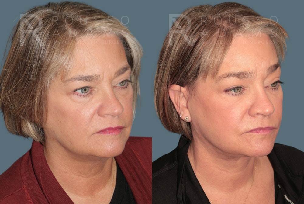 Deep Plane Facelift <span class=small>By Dr. Daniel Rousso</span> Before & After Gallery - Patient 381903 - Image 1