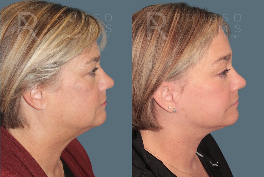 Deep Plane Facelift <span class=small>By Dr. Daniel Rousso</span> Before & After Gallery - Patient 381903 - Image 3