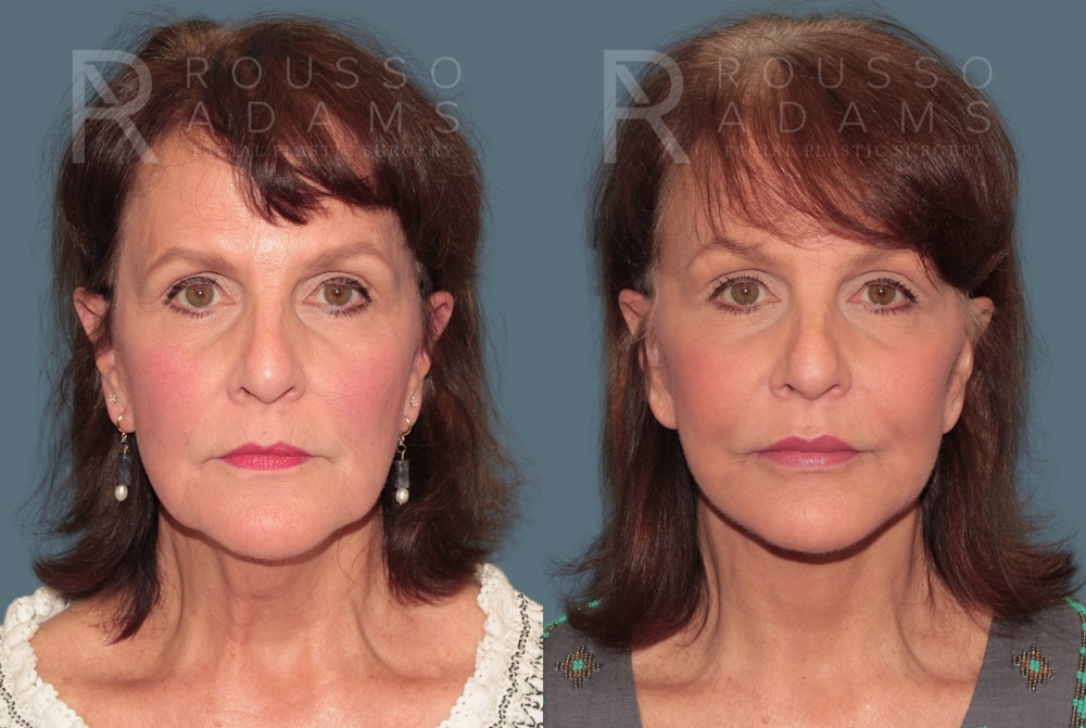 Deep Plane Facelift <span class=small>By Dr. Daniel Rousso</span> Before & After Gallery - Patient 321550 - Image 2