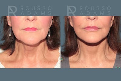 Deep Plane Facelift <span class=small>By Dr. Daniel Rousso</span> Before & After Gallery - Patient 321550 - Image 4