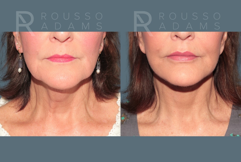 Deep Plane Facelift <span class=small>By Dr. Daniel Rousso</span> Before & After Gallery - Patient 321550 - Image 4
