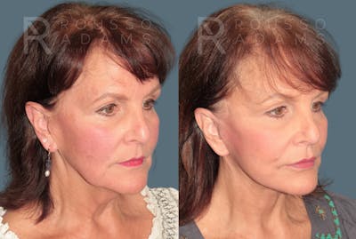 Deep Plane Facelift <span class=small>By Dr. Daniel Rousso</span> Before & After Gallery - Patient 321550 - Image 1