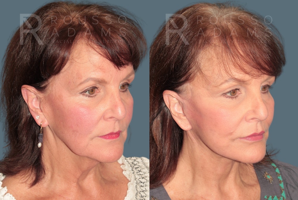 Deep Plane Facelift <span class=small>By Dr. Daniel Rousso</span> Before & After Gallery - Patient 321550 - Image 1
