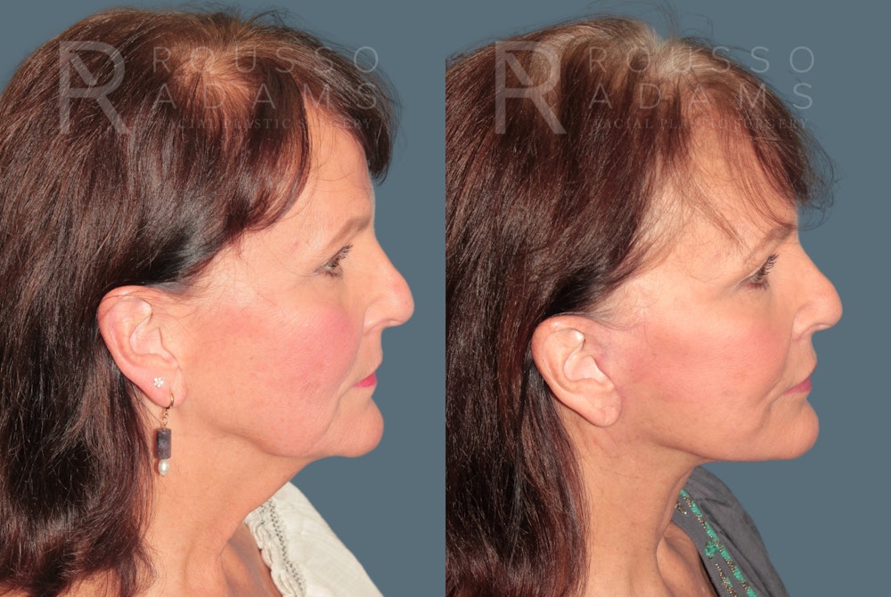 Deep Plane Facelift <span class=small>By Dr. Daniel Rousso</span> Before & After Gallery - Patient 321550 - Image 3
