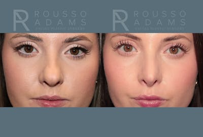 Rhinoplasty <span class=small>By Dr. Daniel Rousso</span> Before & After Gallery - Patient 262958 - Image 2