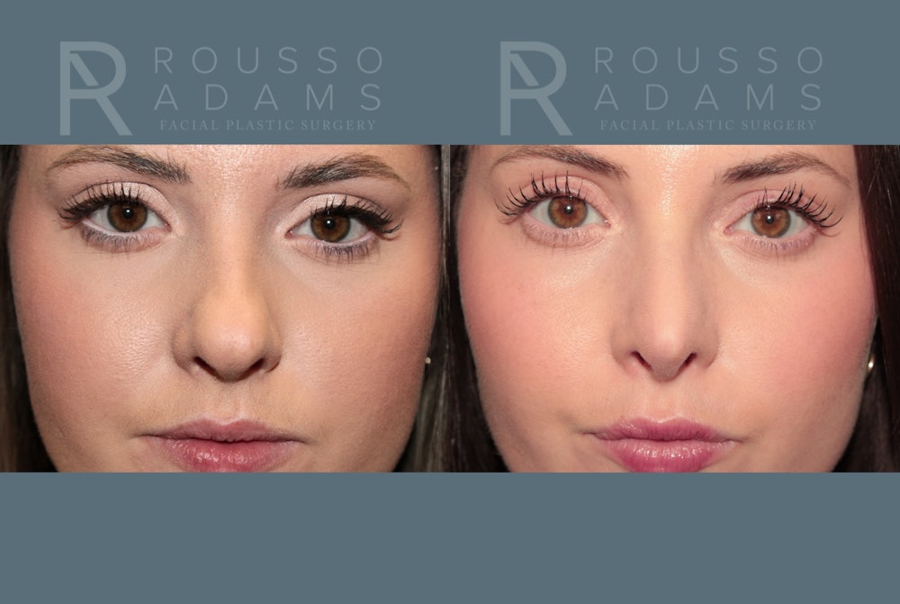 Rhinoplasty <span class=small>By Dr. Daniel Rousso</span> Before & After Gallery - Patient 262958 - Image 2