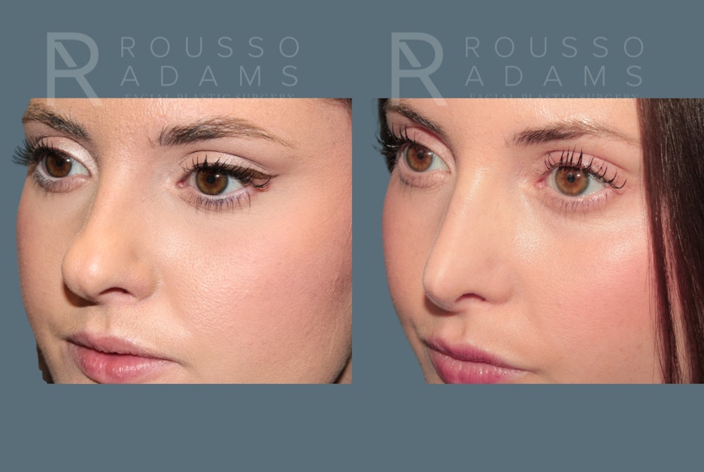 Rhinoplasty <span class=small>By Dr. Daniel Rousso</span> Before & After Gallery - Patient 262958 - Image 3