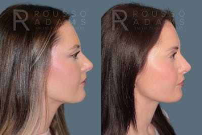 Rhinoplasty <span class=small>By Dr. Daniel Rousso</span> Before & After Gallery - Patient 262958 - Image 1