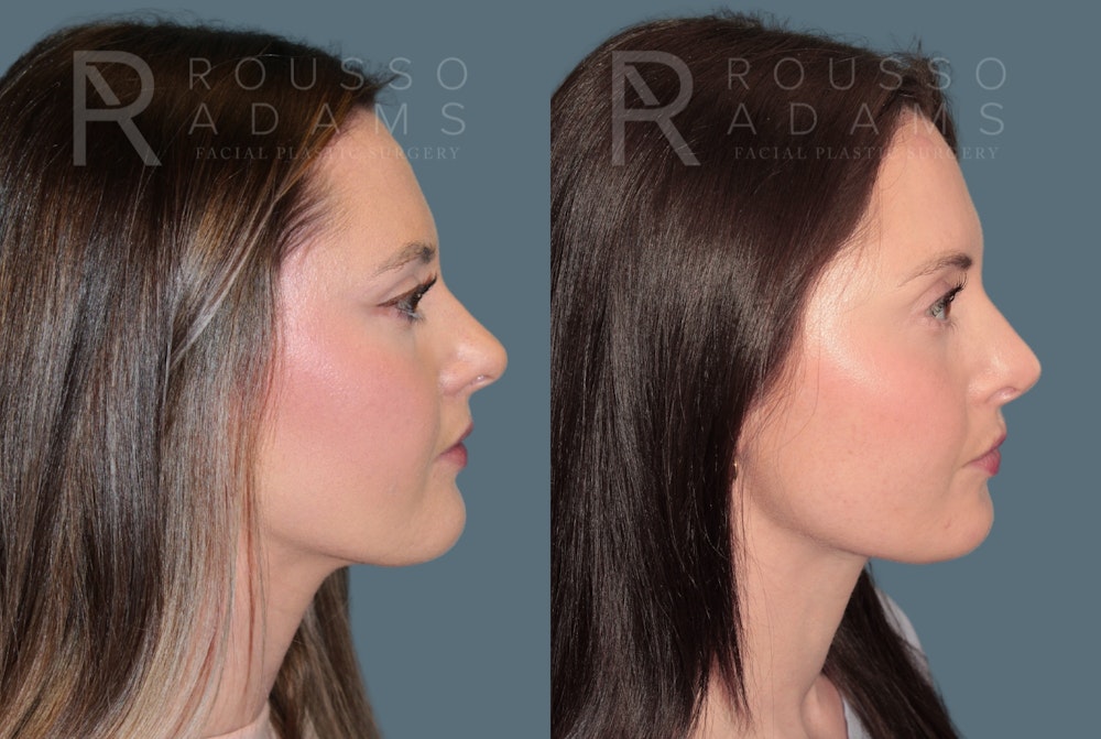 Rhinoplasty <span class=small>By Dr. Daniel Rousso</span> Before & After Gallery - Patient 262958 - Image 1