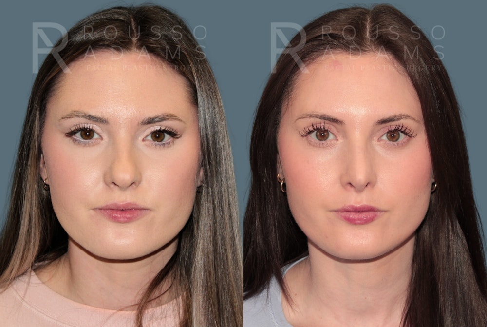 Rhinoplasty <span class=small>By Dr. Daniel Rousso</span> Before & After Gallery - Patient 262958 - Image 5