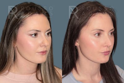 Rhinoplasty <span class=small>By Dr. Daniel Rousso</span> Before & After Gallery - Patient 262958 - Image 4