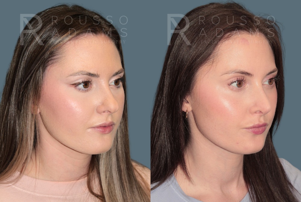 Rhinoplasty <span class=small>By Dr. Daniel Rousso</span> Before & After Gallery - Patient 262958 - Image 4