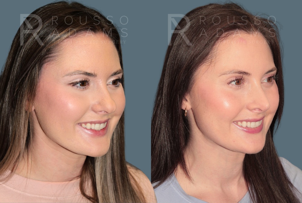 Rhinoplasty <span class=small>By Dr. Daniel Rousso</span> Before & After Gallery - Patient 262958 - Image 6