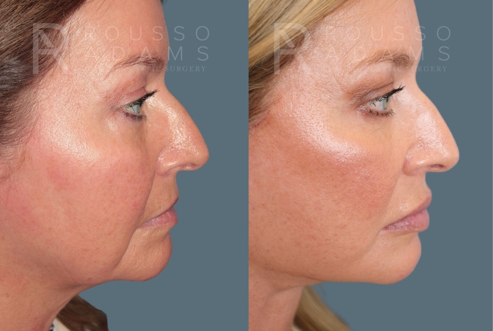 Deep Plane Facelift <span class=small>By Dr. Daniel Rousso</span> Before & After Gallery - Patient 301385 - Image 5