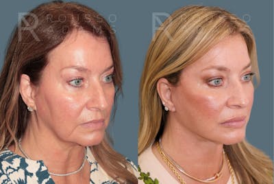 Deep Plane Facelift <span class=small>By Dr. Daniel Rousso</span> Before & After Gallery - Patient 301385 - Image 1